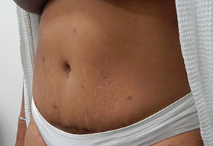 Abdominoplasty