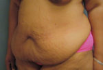 Abdominoplasty