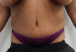 Abdominoplasty