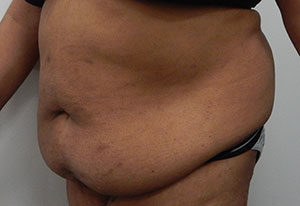 Abdominoplasty