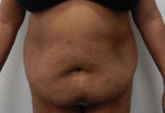 Abdominoplasty