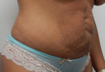 Abdominoplasty