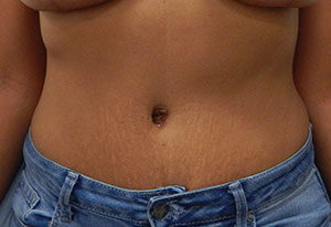 Abdominoplasty