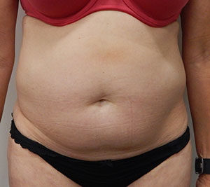 Abdominoplasty