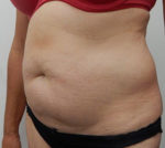 Abdominoplasty