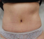 Abdominoplasty