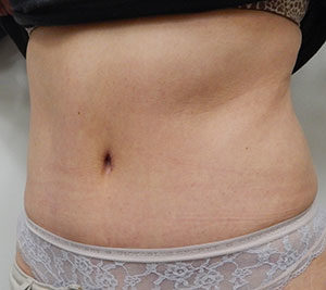 Abdominoplasty