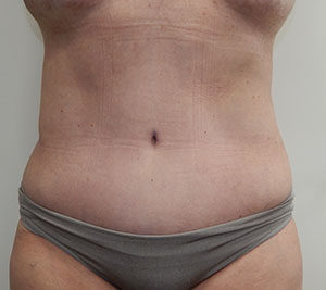 Abdominoplasty