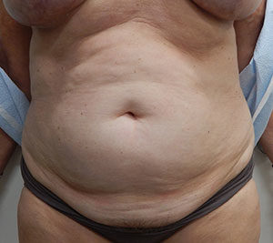 Abdominoplasty