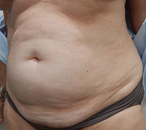 Abdominoplasty