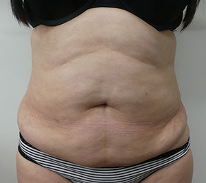 Abdominoplasty