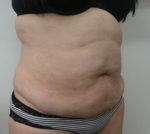 Abdominoplasty