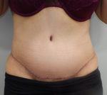 Abdominoplasty