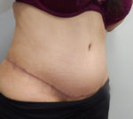 Abdominoplasty