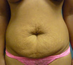 Abdominoplasty