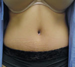 Abdominoplasty