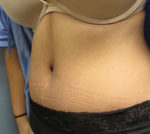 Abdominoplasty