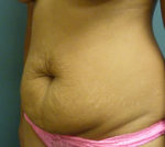 Abdominoplasty