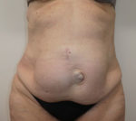 Abdominoplasty