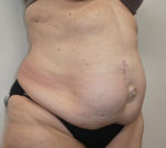 Abdominoplasty