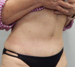 Abdominoplasty