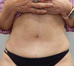 Abdominoplasty