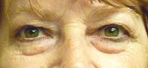 Blepharoplasty