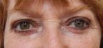 Blepharoplasty