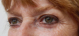 Blepharoplasty