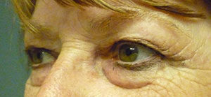 Blepharoplasty