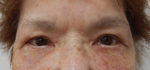 Blepharoplasty