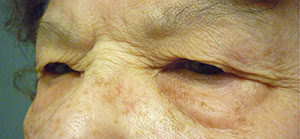 Blepharoplasty