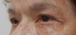 Blepharoplasty