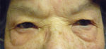 Blepharoplasty