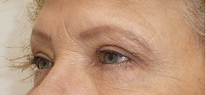 Blepharoplasty