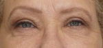 Blepharoplasty