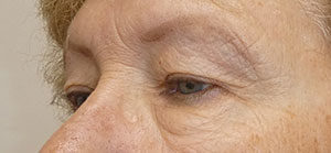 Blepharoplasty