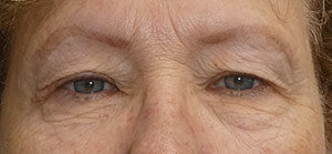 Blepharoplasty