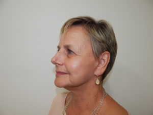 Facelift
