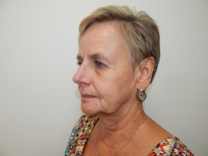Facelift