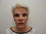 Facelift