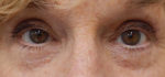 Blepharoplasty