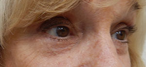 Blepharoplasty