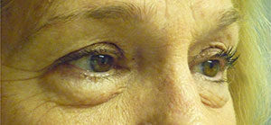 Blepharoplasty