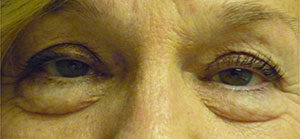 Blepharoplasty