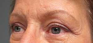 Blepharoplasty