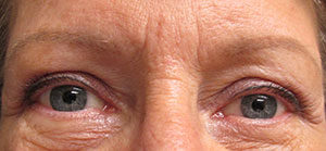 Blepharoplasty