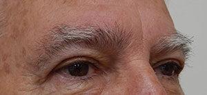 Blepharoplasty