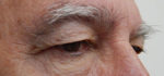 Blepharoplasty