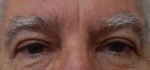 Blepharoplasty